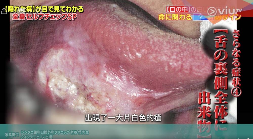 舌癌特徵｜脷底生粒粒是飛滋還是舌癌？醫生教你2招分辨及早治療