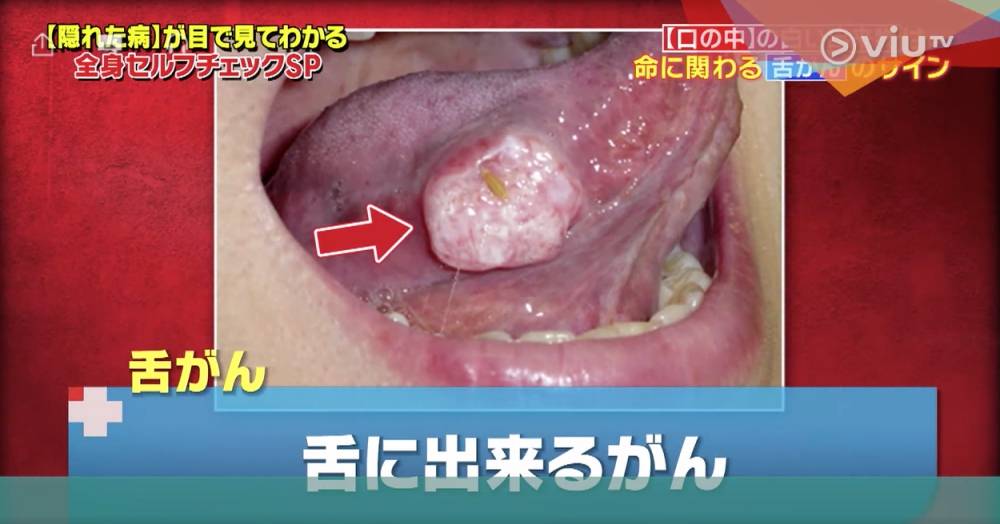 舌癌特徵｜脷底生粒粒是飛滋還是舌癌？醫生教你2招分辨及早治療