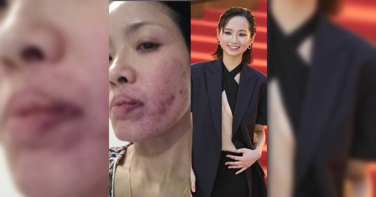 掌摑前輩寶珮如致半邊面瘀黑爆血管 梁雍婷首開腔還原震撼真相